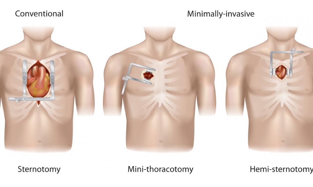 Tutta la cardiochirurgia può essere invasiva