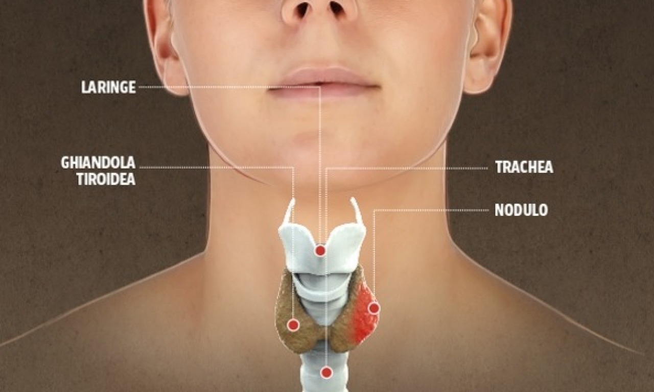 I noduli della tiroide. Quando una tiroide che funziona bene deve comunque essere operata